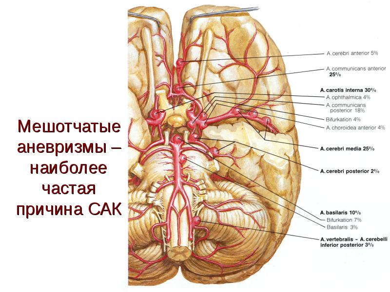 Лечение геморрагического инсульта презентация