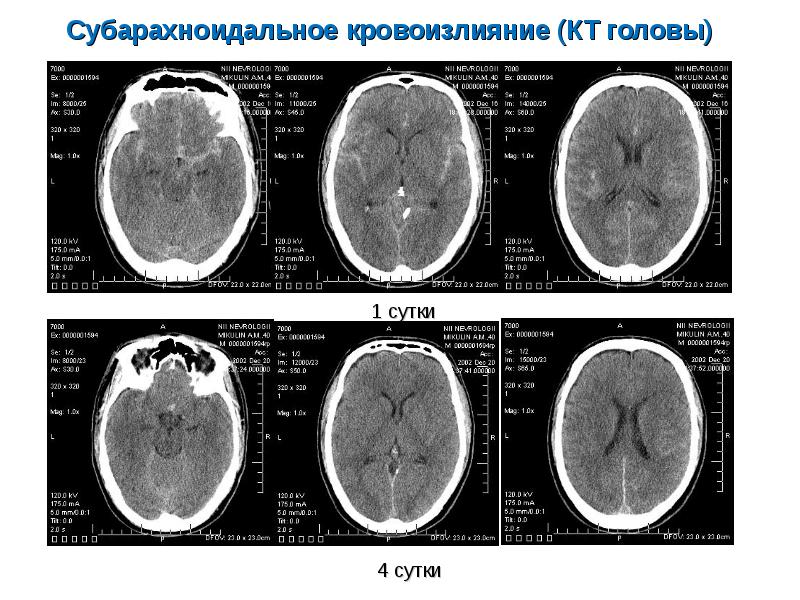 Лечение геморрагического инсульта презентация