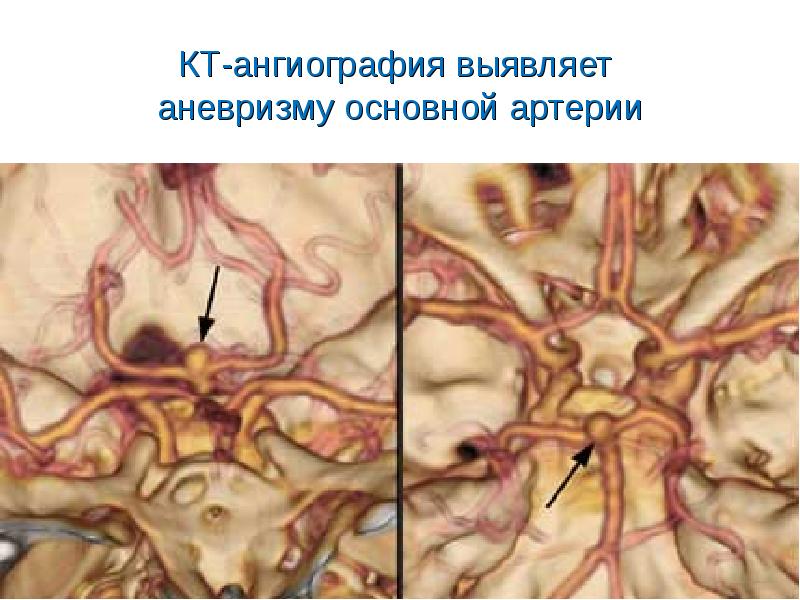 Лечение геморрагического инсульта презентация