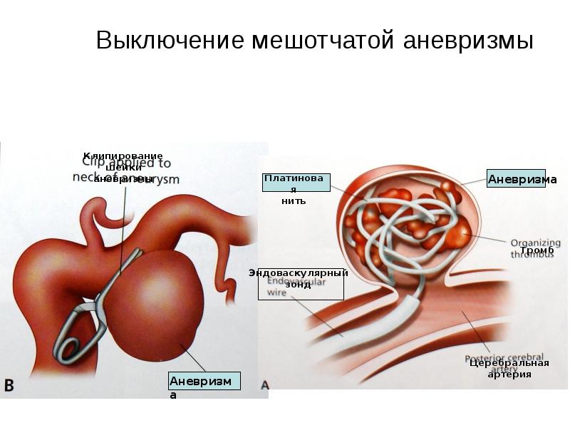 Лечение геморрагического инсульта презентация