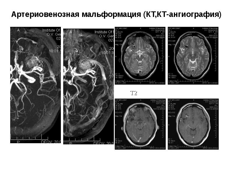 Лечение геморрагического инсульта презентация