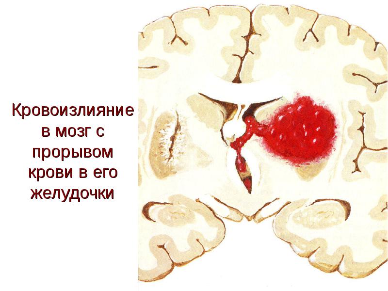 Лечение геморрагического инсульта презентация