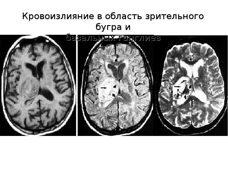 Лечение геморрагического инсульта презентация