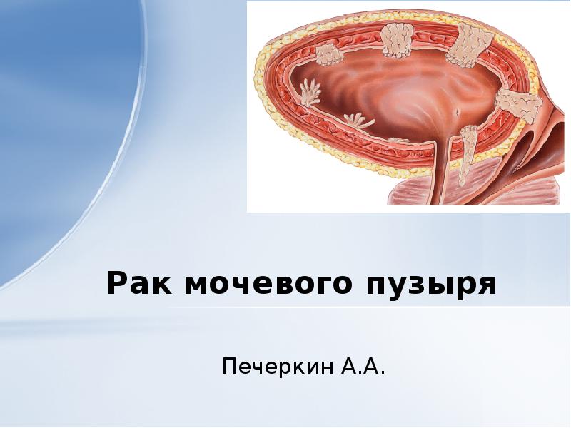 Презентация на тему рак мочевого пузыря