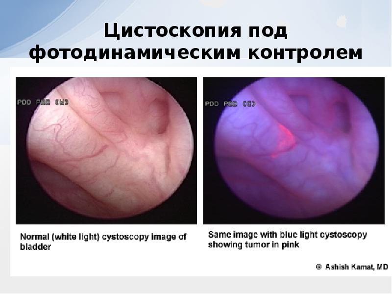 Презентация на тему рак мочевого пузыря