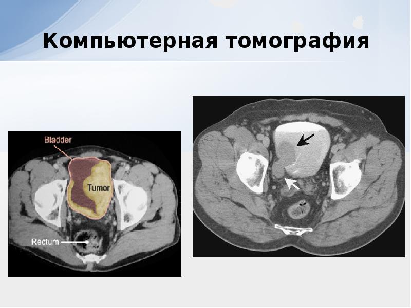 Презентация на тему рак мочевого пузыря