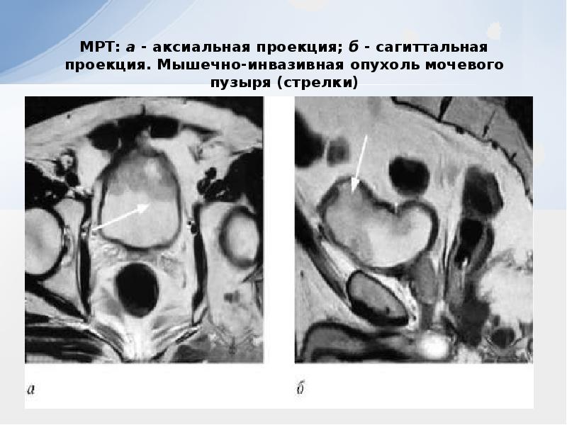 Презентация на тему рак мочевого пузыря