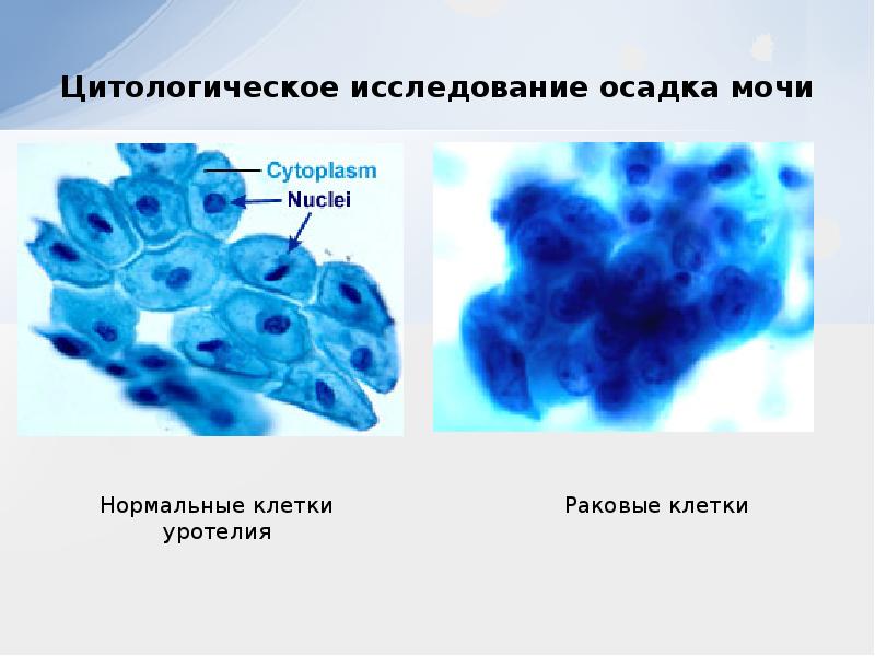 Презентация на тему рак мочевого пузыря