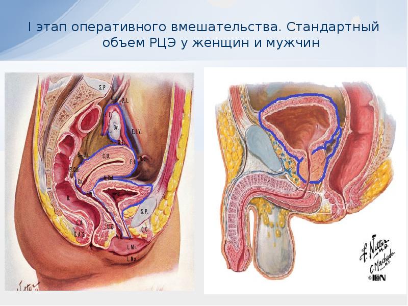 Презентация на тему рак мочевого пузыря