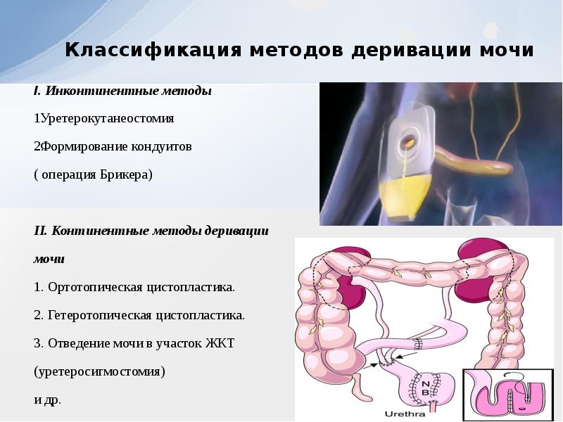 Презентация на тему рак мочевого пузыря