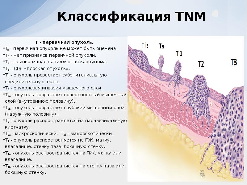 Презентация на тему рак мочевого пузыря