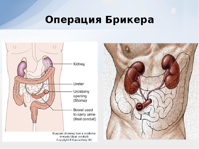 Презентация на тему рак мочевого пузыря