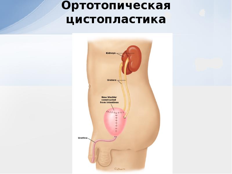 Презентация на тему рак мочевого пузыря