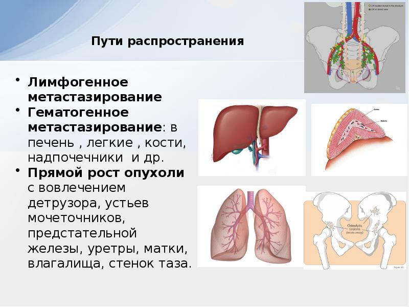 Презентация на тему рак мочевого пузыря