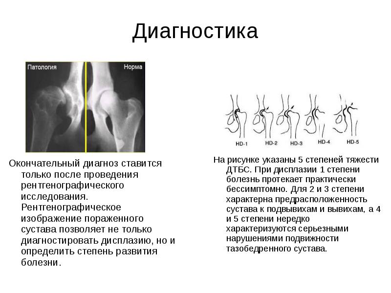 Презентация дисплазия тазобедренных суставов