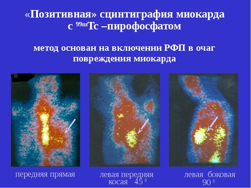 Сцинтиграфия миокарда. Сцинтиграфия сосудов. Сцинтиграфия сосудов сердца. Сцинтиграфия позитив позитивная.