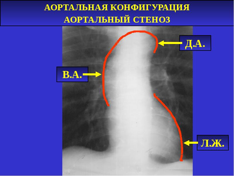 Аортальная конфигурация сердца