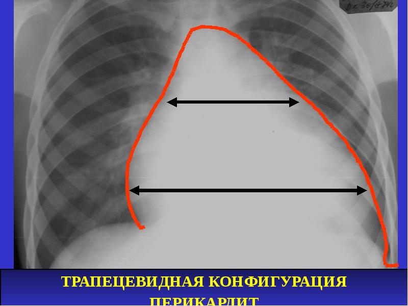 Лучевая диагностика средостения презентация