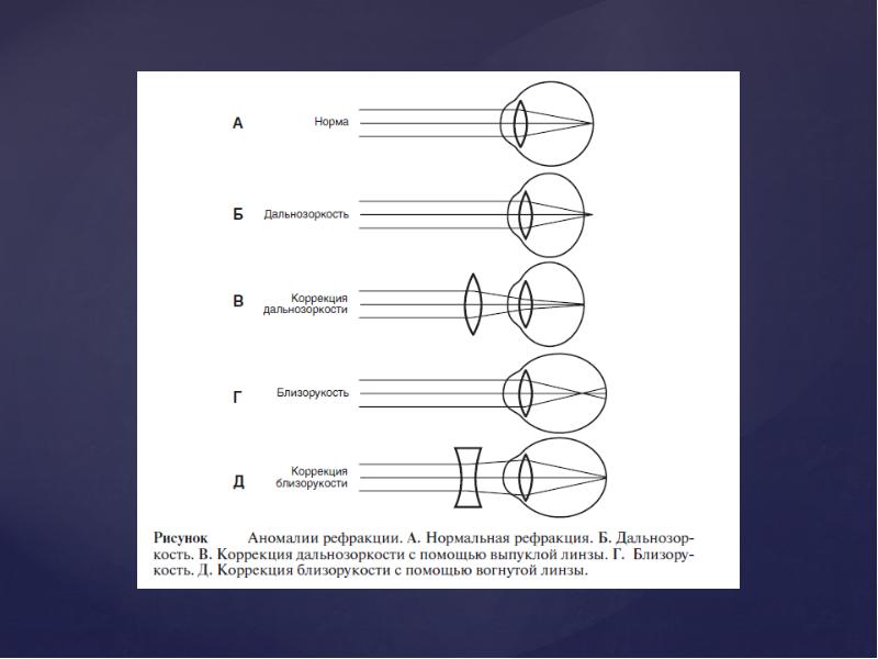 Близорукость дальнозоркость схема