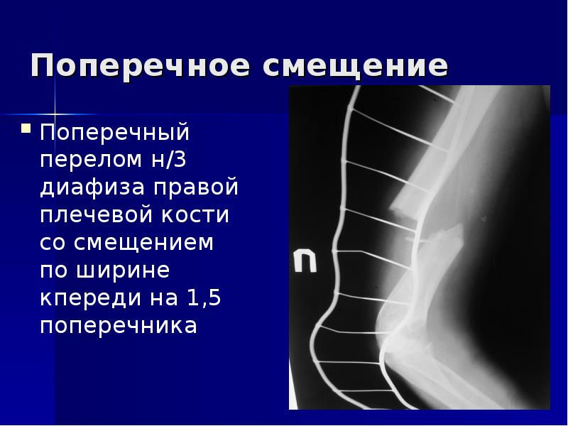 Поперечный перелом