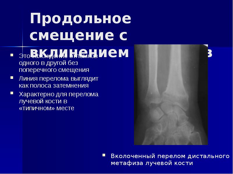 Рентгенодиагностика переломов презентация