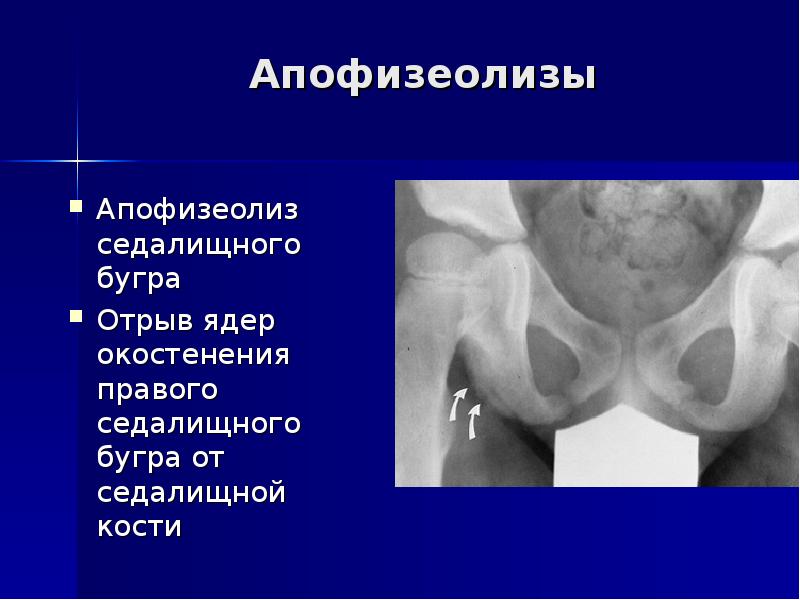 Рентгенодиагностика переломов презентация