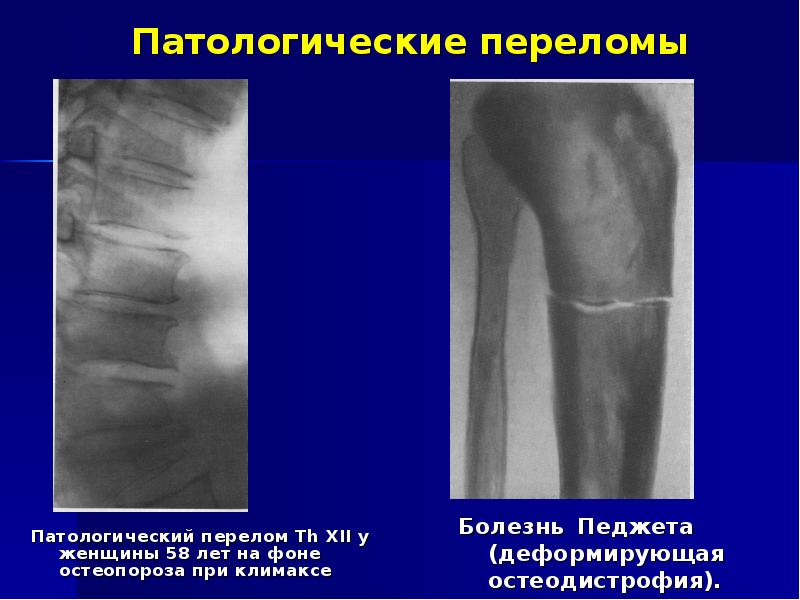 Рентгенодиагностика переломов презентация