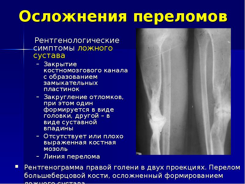 Травматология переломы презентация