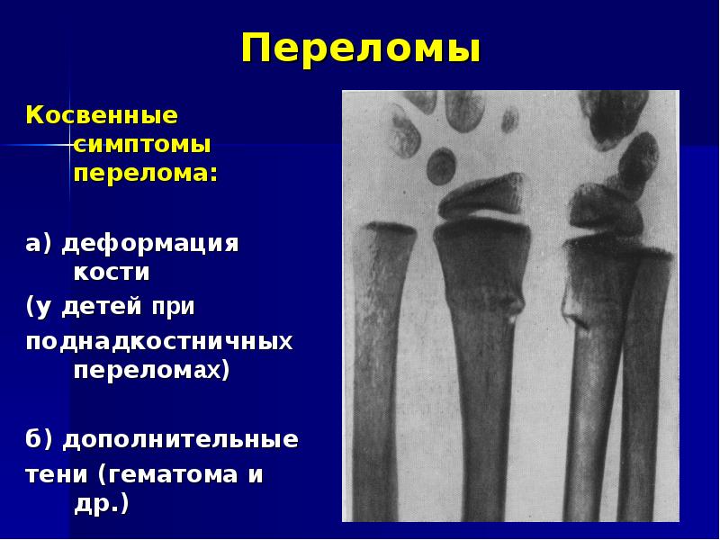 Рентгенодиагностика переломов презентация