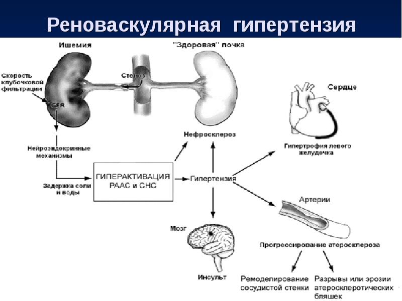 Первичная артериальная гипертензия презентация