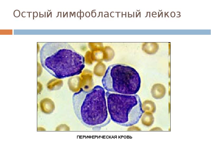 Жедел лейкоз презентация