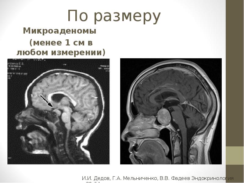 Мр картина микроаденомы гипофиза что это