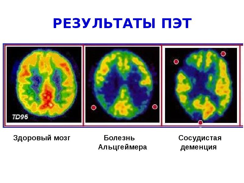 Результаты пэт