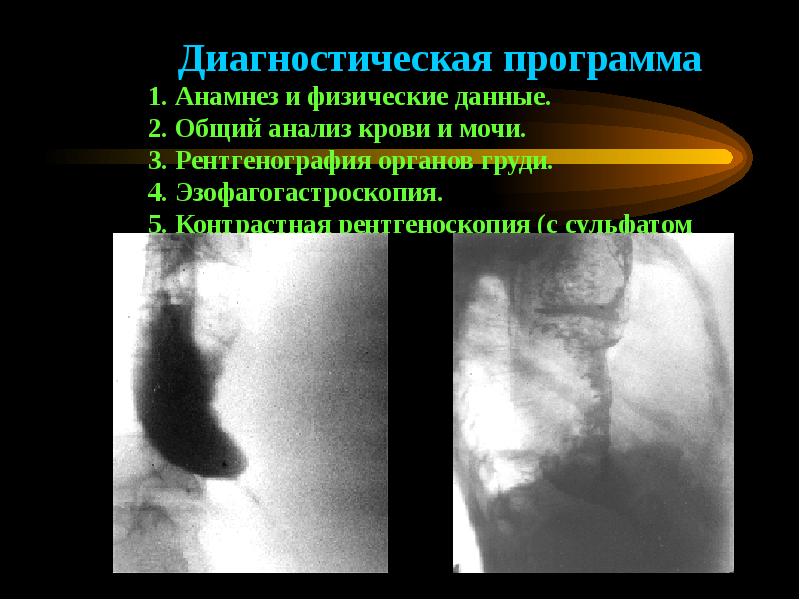 Заболевания пищевода хирургия презентация