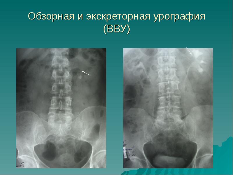 Лечение мочекаменной болезни презентация