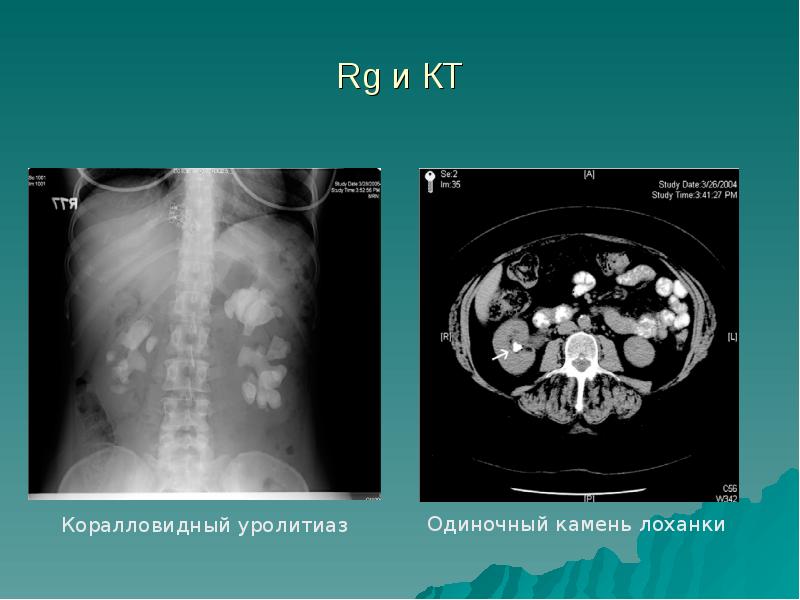 Лечение мочекаменной болезни презентация