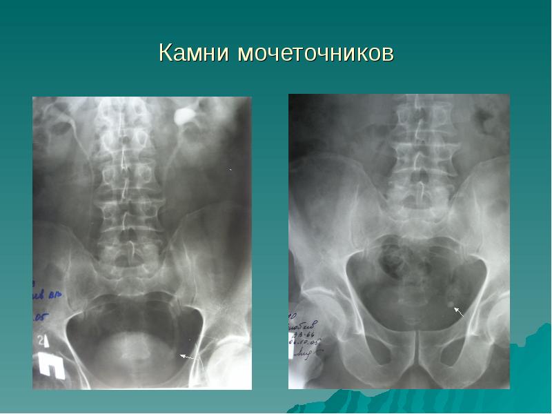 Лечение мочекаменной болезни презентация