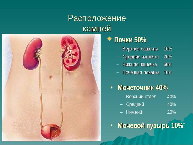 Презентация по мочекаменной болезни