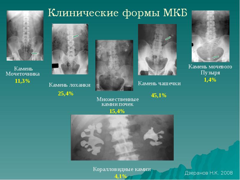 Презентация по мочекаменной болезни