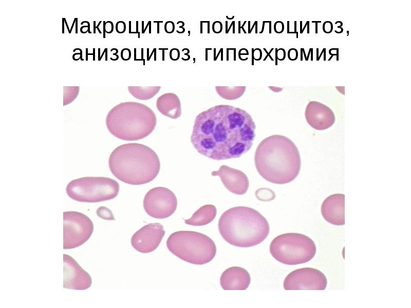 Анизоцитоз в общем анализе крови. Анизоцитоз. Анизо и пойкилоцитоз. Макроцитоз в общем анализе крови что это такое.