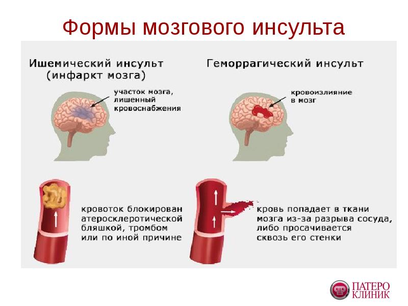 Проект про инсульт