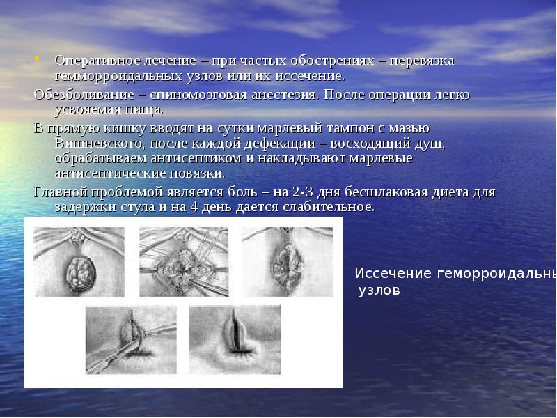 Восстановление стула после операции