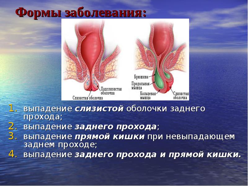 Выпадение прямой кишки презентация