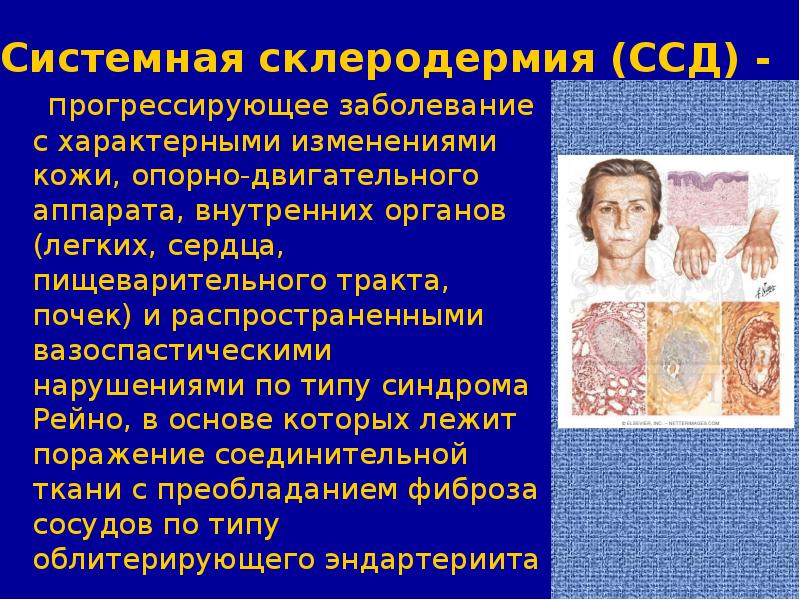 Доклад: Склеродермия