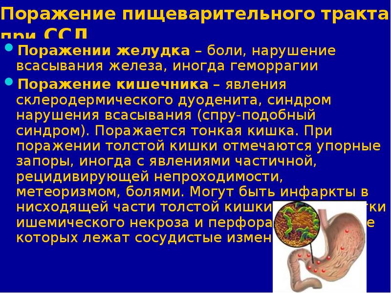 Какой поражение. Склеродермическое поражение пищеварительного тракта. Системная склеродермия поражение ЖКТ. Поражение ЖКТ при склеродермии. Поражение желудка при склеродермии.