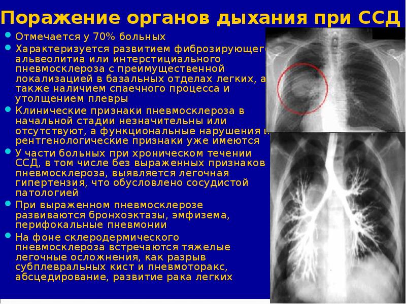 Легочный рисунок диффузно усилен за счет интерстициального компонента