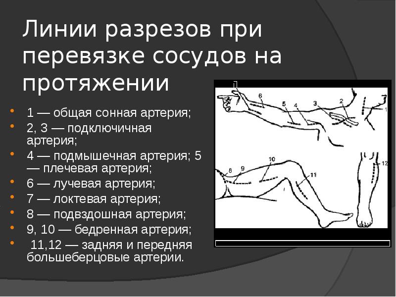 На протяжении или на протяжение. Перевязка лучевой артерии. Перевязка артерии на протяжении. Перевязка сосуда на протяжении. Перевязка плечевой артерии на протяжении.