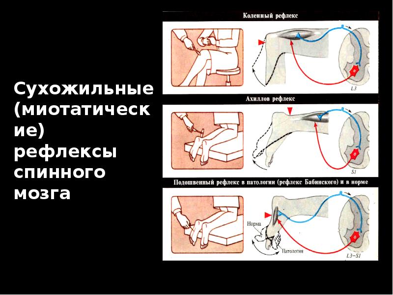 Исследование кожных рефлексов. Сухожильные и миотатические рефлексы. Сухожильные рефлексы человека физиология. Оценка сухожильных рефлексов. Сухожильные рефлексы рефлексов.