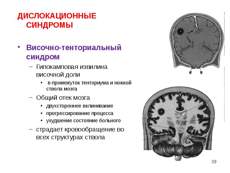 Синдром головного мозга. Дислокационный синдром височно-тенториальный. Дислокационный синдром при опухолях головного мозга. Гипертензионно-дислокационный синдром. Дислокационный синдром неврология.