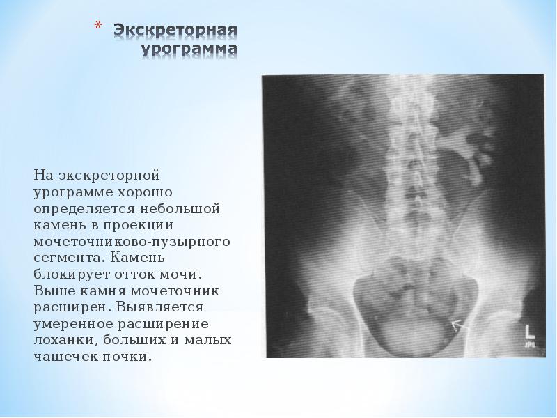 Лучевая диагностика заболеваний почек презентация